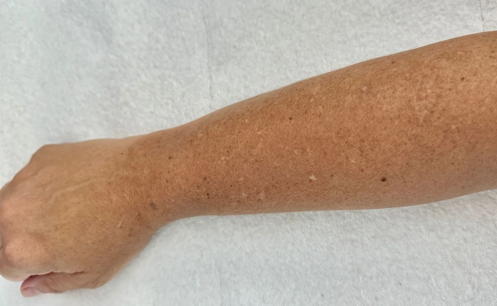 The advance scar camouflage for sun damage: The Solution for White sun spots caused by sun damage
