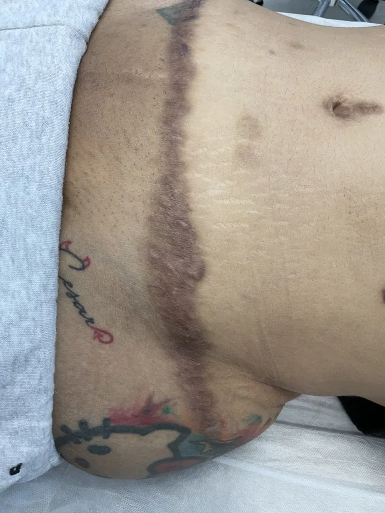 Scar Healing Timeline: Why 3 to 18 Months is Critical for Maturation