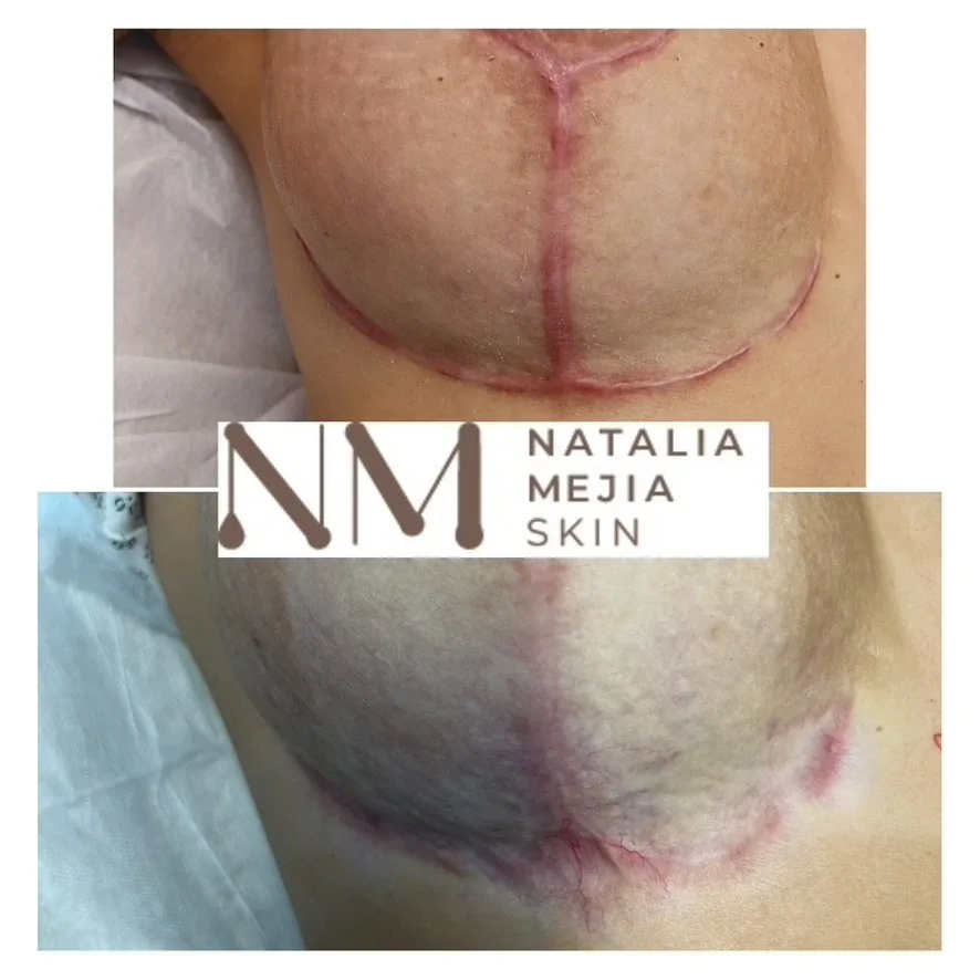 Scar Heal Time: Why 45-60 Days Makes All the Difference in Scar Treatment Success