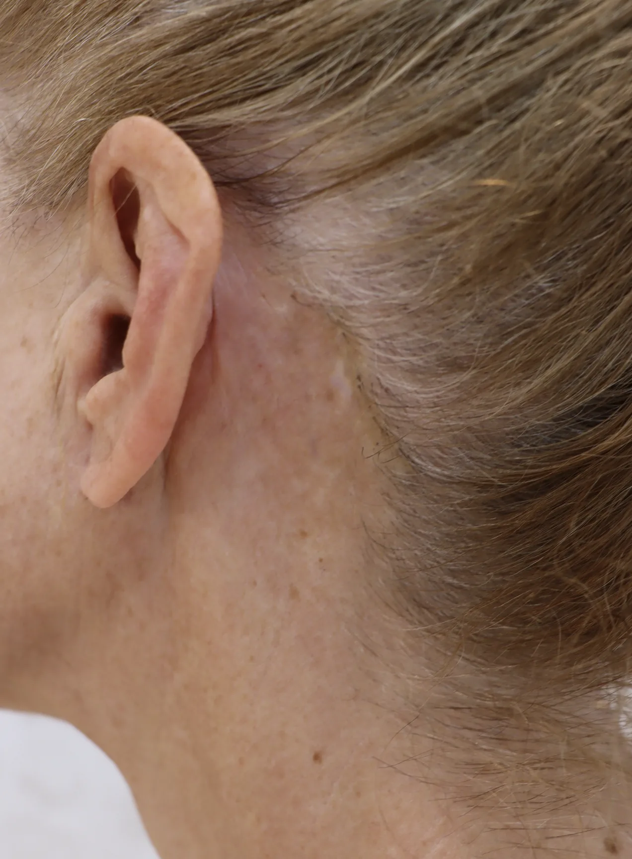 Why the Popularity of Scar Camouflage Tattoos is Growing