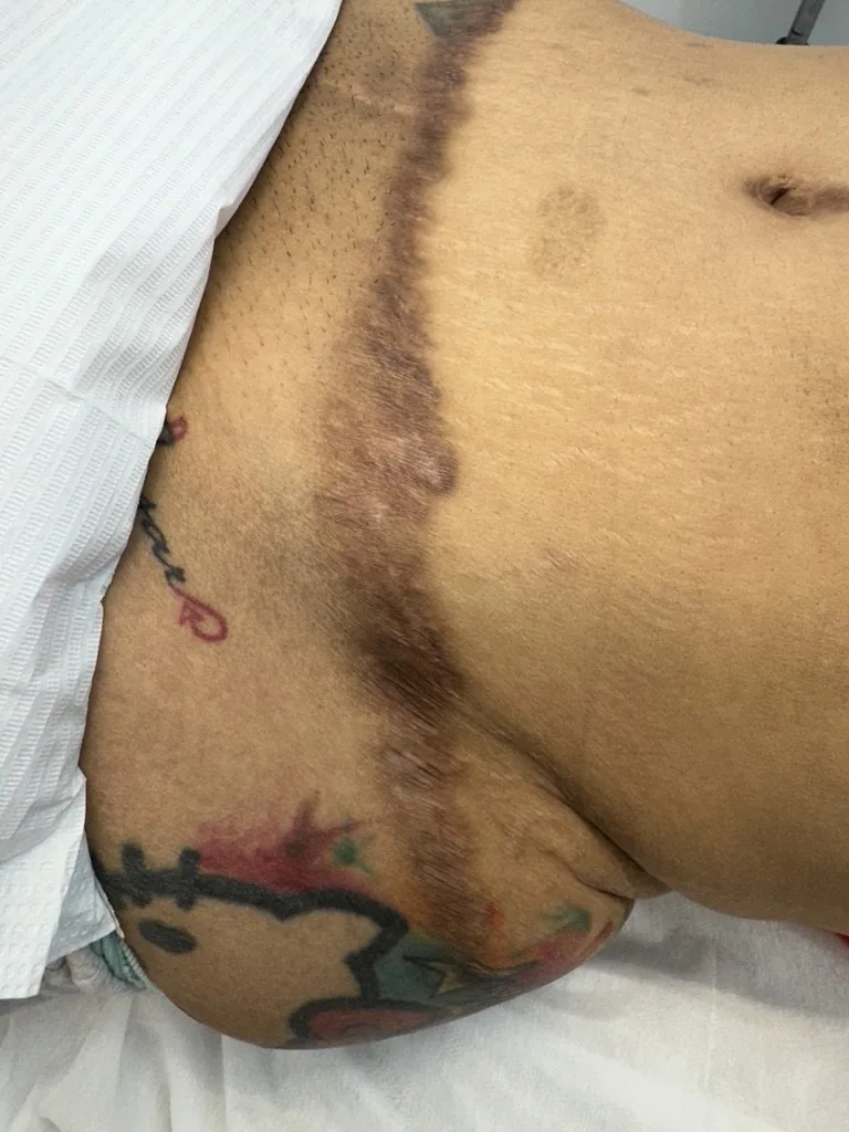 Dark Scar, The Truth Behind: How to Prevent Scar Hyperpigmentation After Surgery