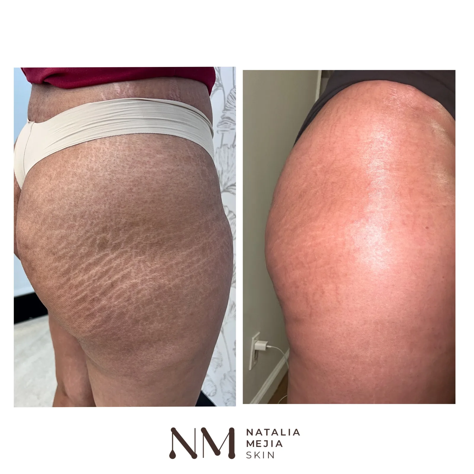 Stretch Mark Tattoo: A Guide to Camouflage & Tattooing Stretch Marks