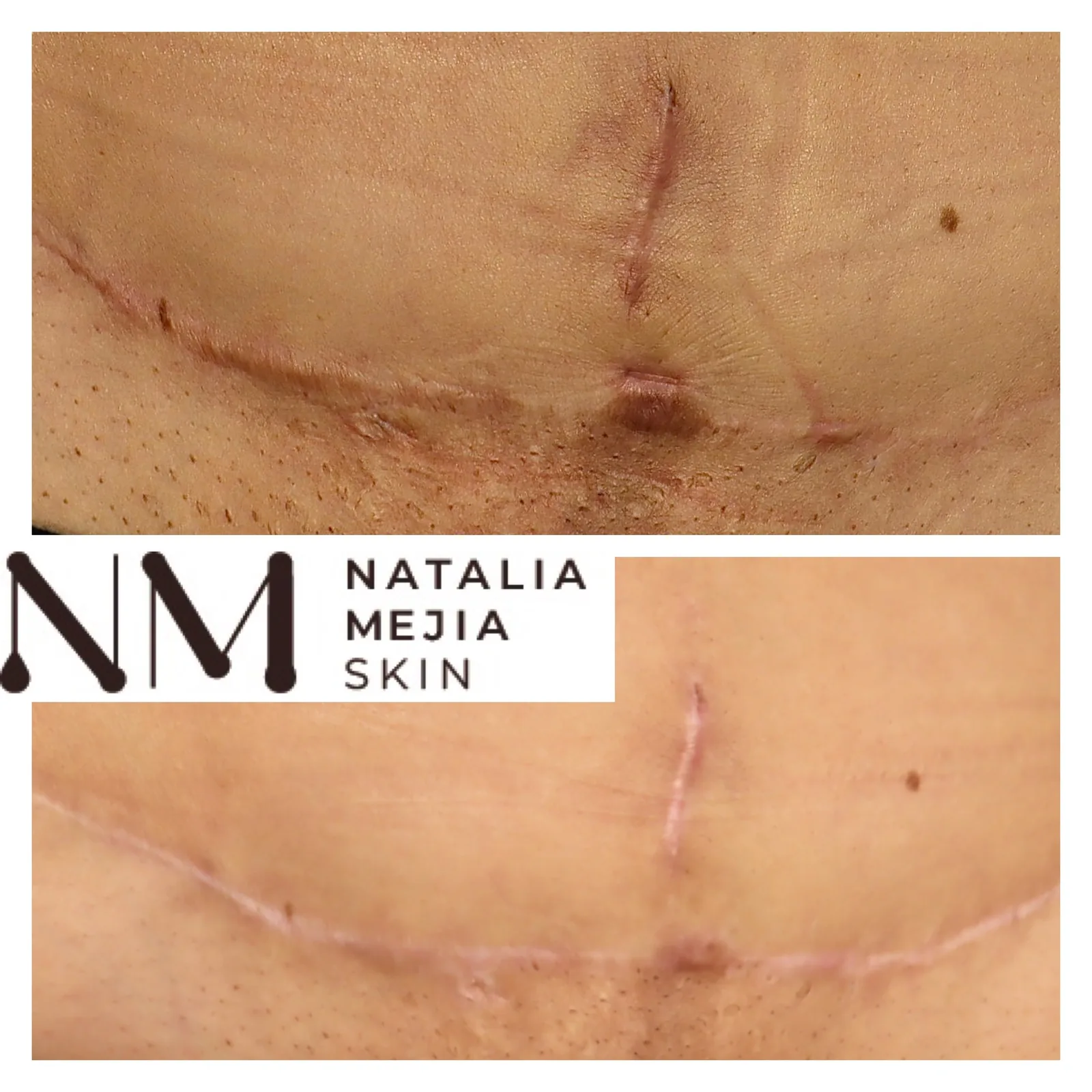 Scar Management and Camouflage, Integrating Regenerative Treatments