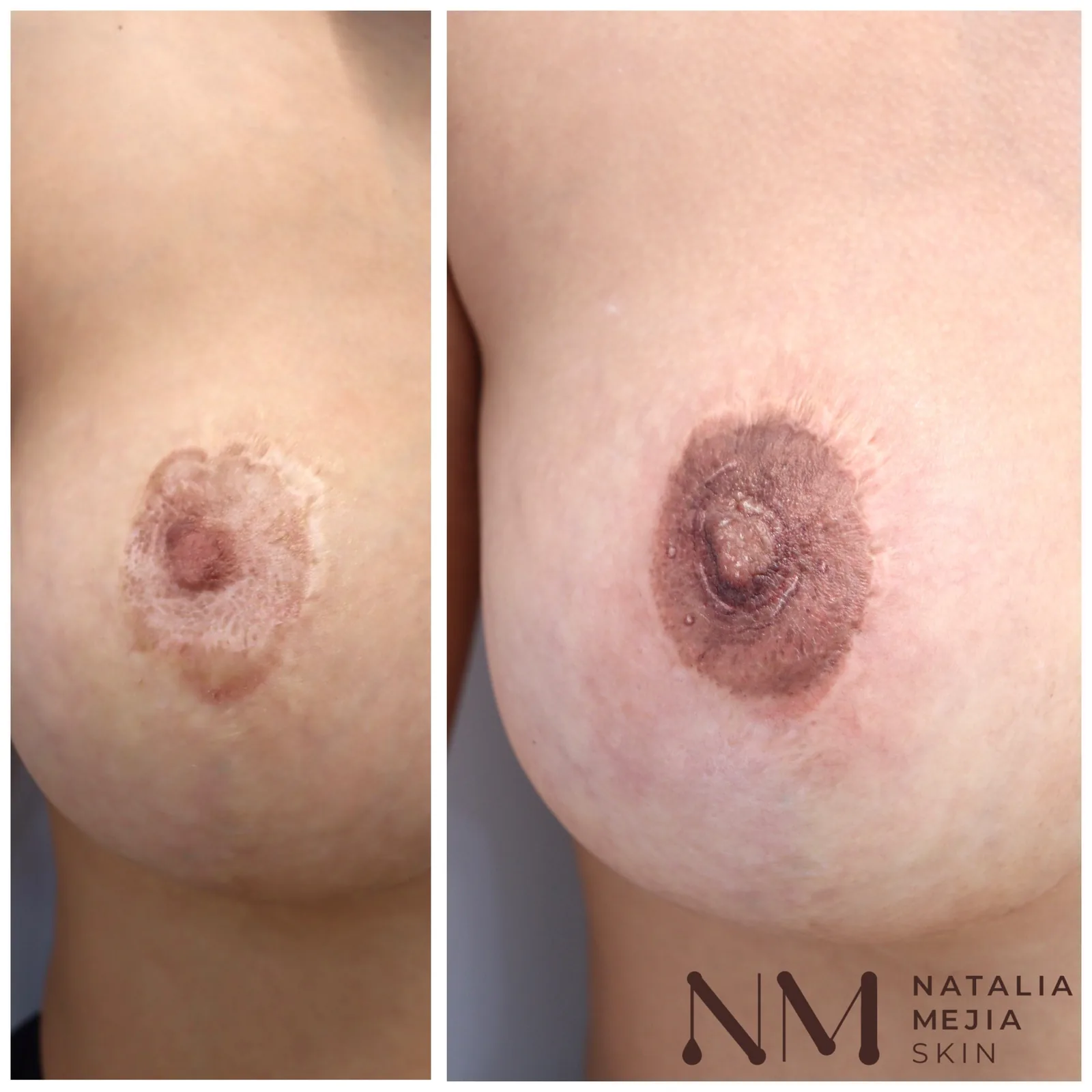 Do Tattooed Nipples Look Real? A Closer Look at 3D Areola Tattooing