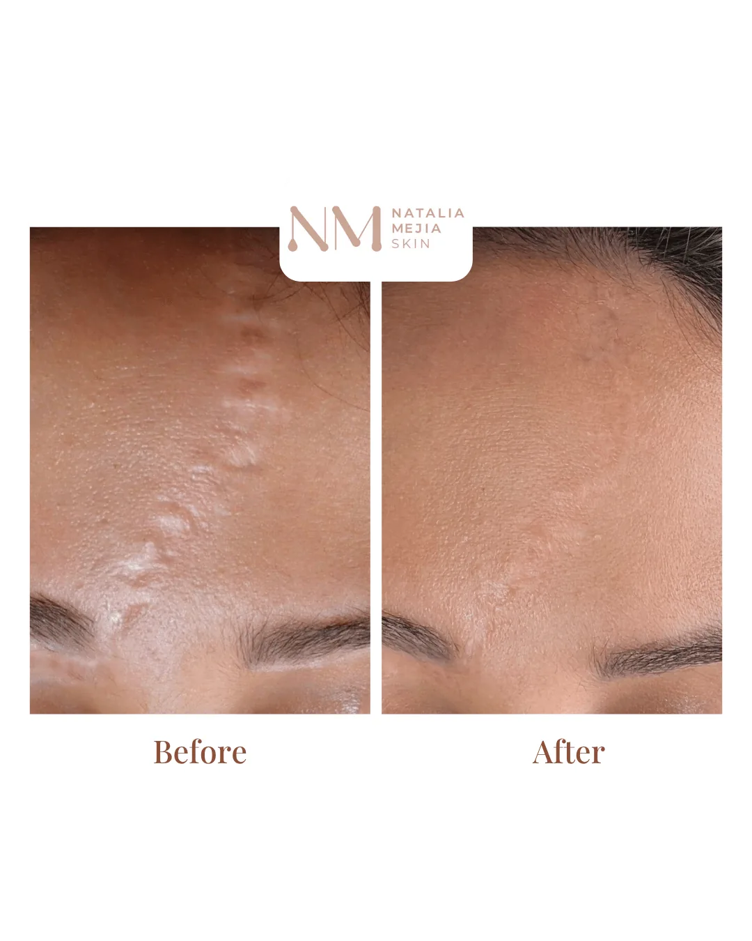 Non-Surgical Scar Revision: Can Scar Tissue Be Removed Without Surgery?