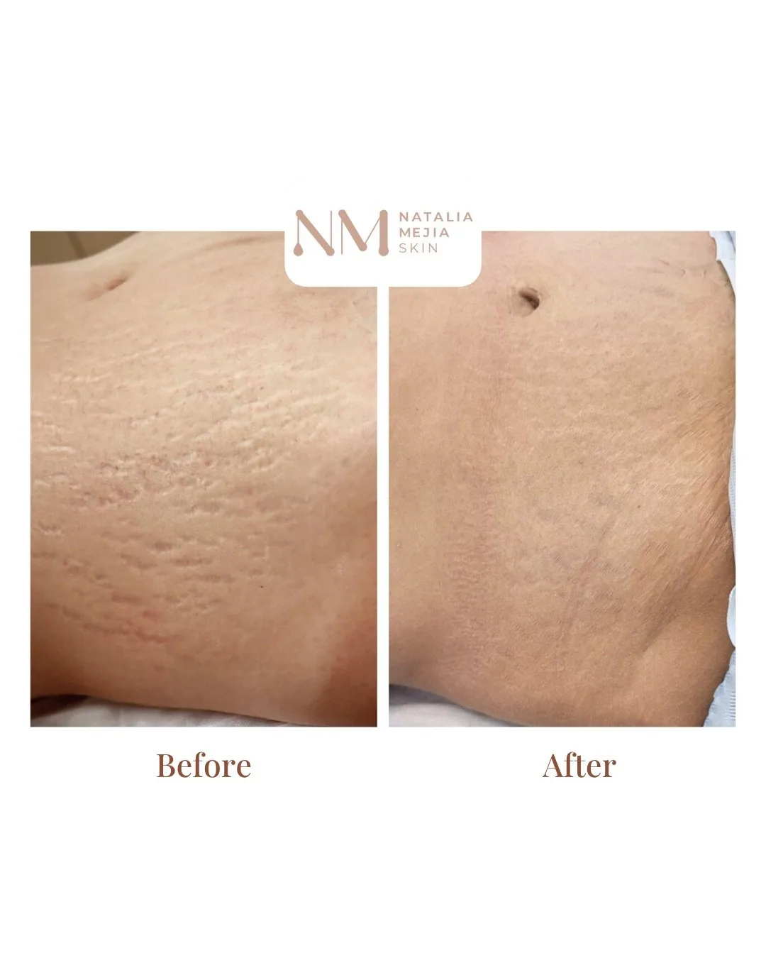 Stretch Mark Camouflage: Understanding the Healing Process