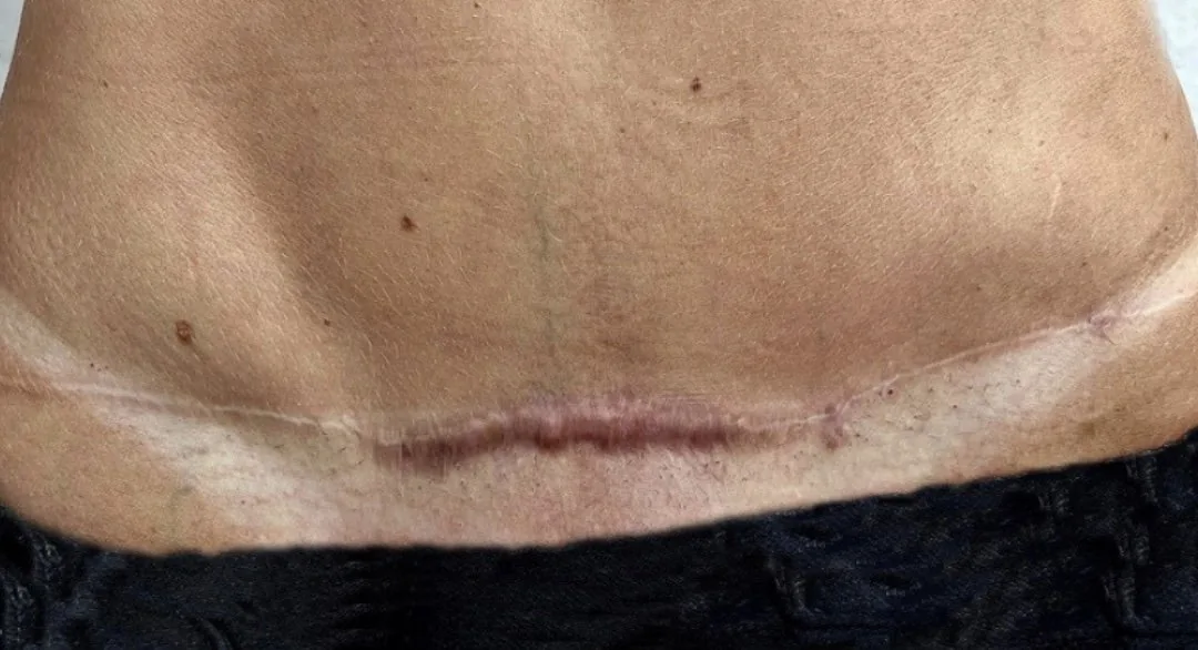 Will a Hypertrophic Scar Go Away? And How Long Does It Take?