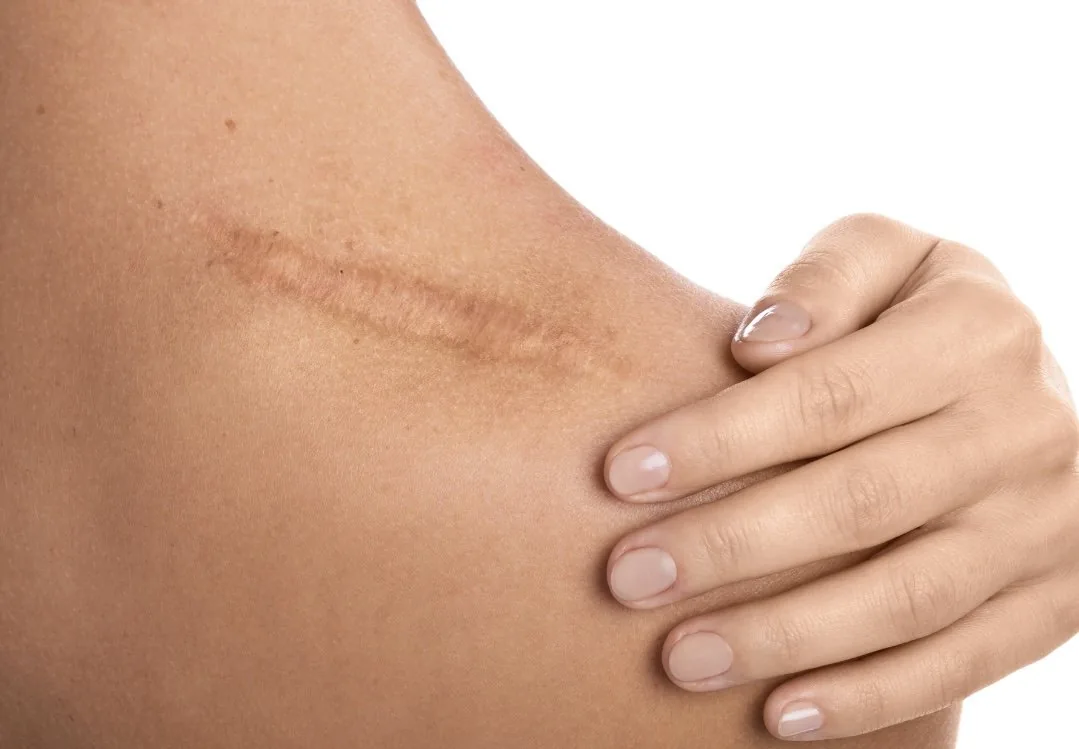 Can You Tattoo Scar Tissue? Everything You Need to Know Before Your Transformation