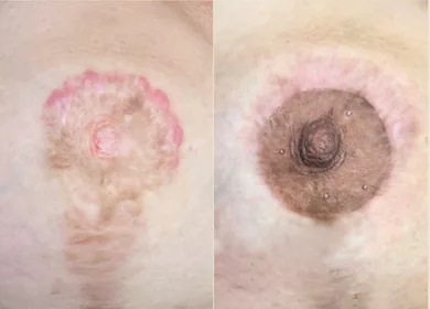 Transforming Breast Scars: My Guide to Areola Revision & Tattoo Camouflage