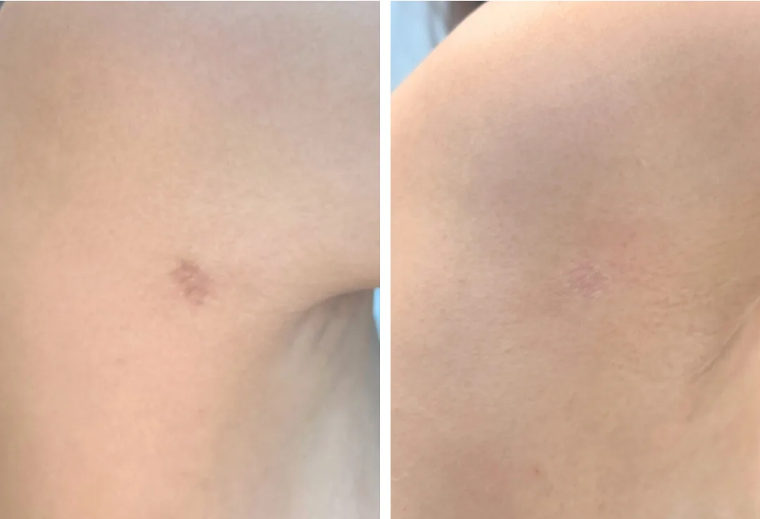 Liposuction Complications: The 5 Most Common After Surgery
