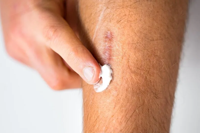 Why Scar Creams Don’t Work on Mature Scars — And What Actually Helps
