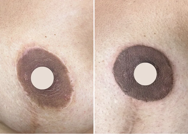 Areola Reconstruction After Breast Surgery: Finding Hope After Necrosis or Mastectomy