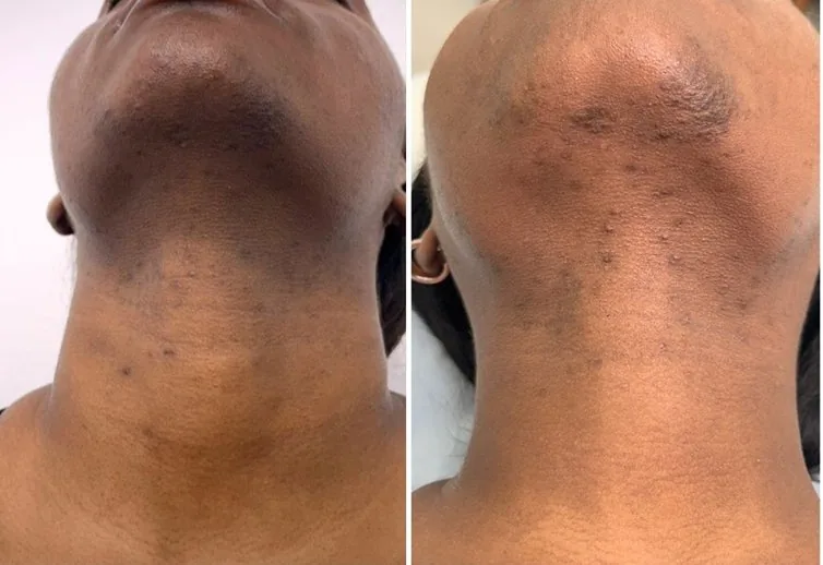 The Natural Peel That Helps Improve Stubborn Dark Spots — Even in Sensitive Areas