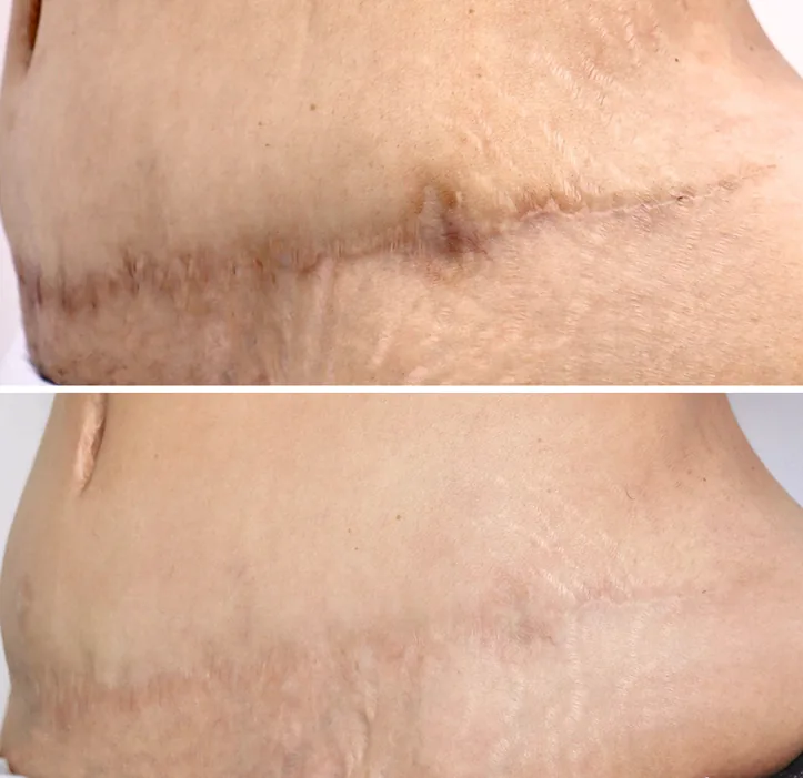 When a Tummy Tuck Scar Doesn’t Heal as Expected: Understanding Your Options