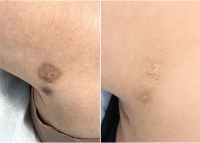 Regeneration First: Why Preparing the Skin Changes Scar Camouflage Results