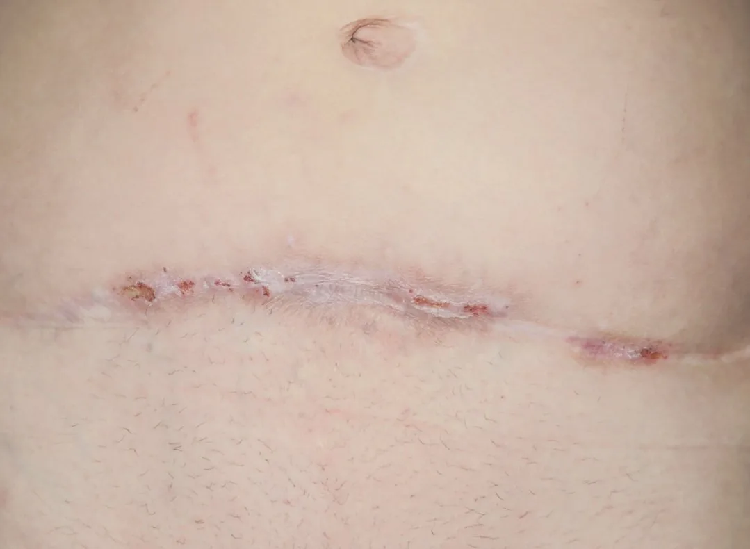 How Tight Clothing and Friction Can Affect Scar Healing