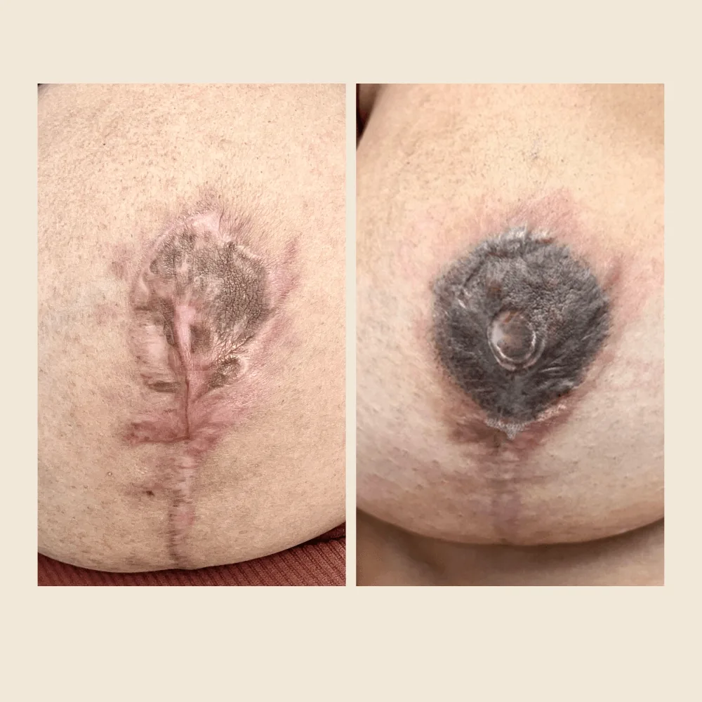 Areola Necrosis After Surgery: Understanding Your Recovery Options