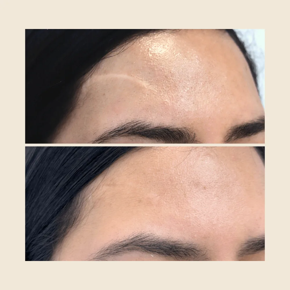 Still Expecting Fast Results for Your Scar? Here’s the Truth About Real Transformation
