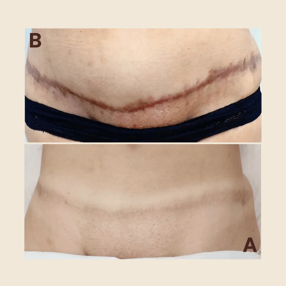 Why Winter Is the Best Time to Start Scar Treatment: From Regeneration to Camouflage — and Summer Confidence