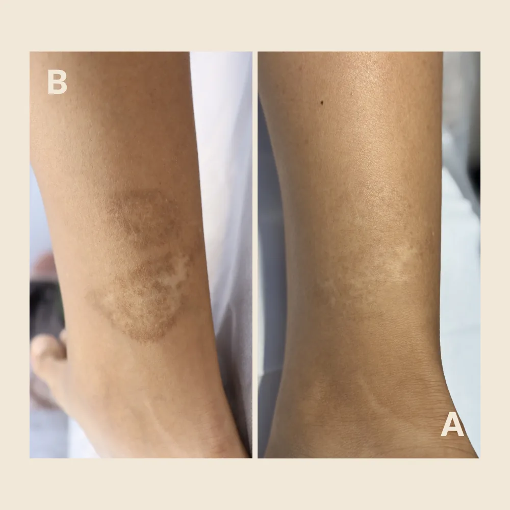 Burn Scar Treatment: Why These Scars Require Specialized Care