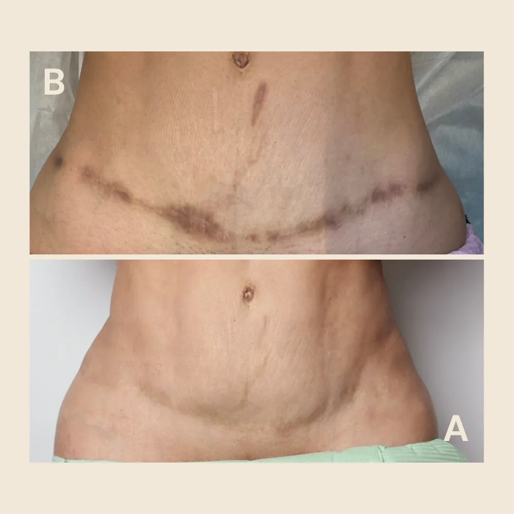 Camouflage Tattoo for Hyperpigmentation: How Dark Scars Are Neutralized