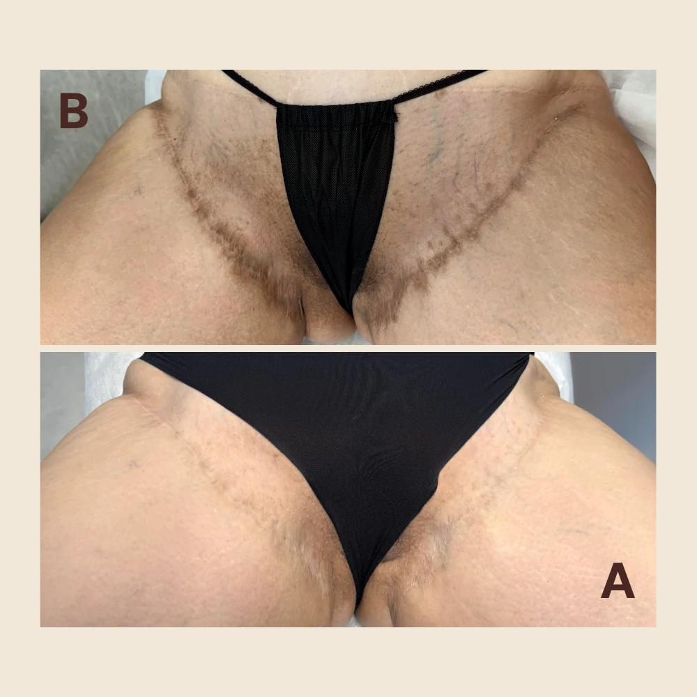 How to Naturally Improve Scars: Why Regeneration Comes Before Camouflage
