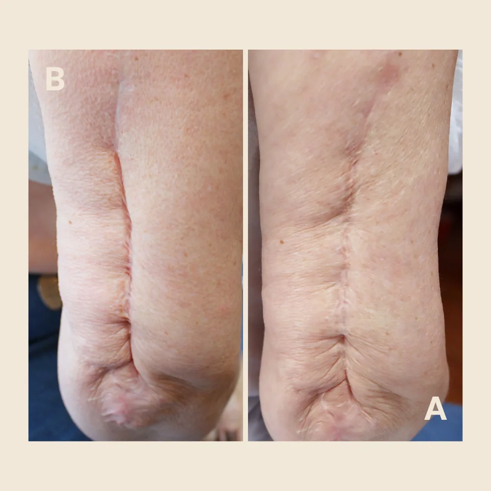 Before and after hypertrophic scar treatment on the arm: a raised, pink surgical scar before treatment, then flattened and blended to match the surrounding skin tone