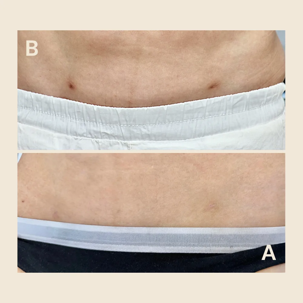Before and after liposuction scar camouflage on the lower abdomen: two small dark port-site scars above the waistband, then faded to match the surrounding skin tone