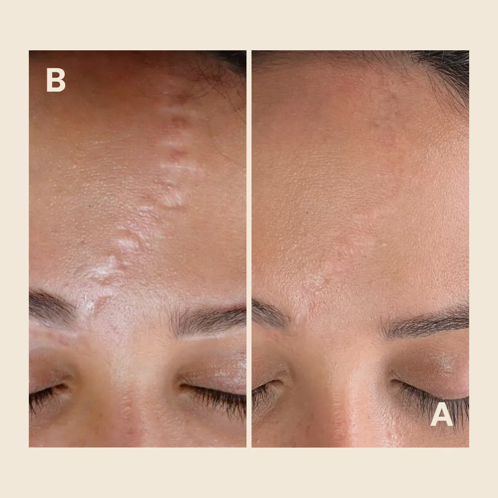Non-Surgical Scar Revision: Can Scar Tissue Be Removed Without Surgery?