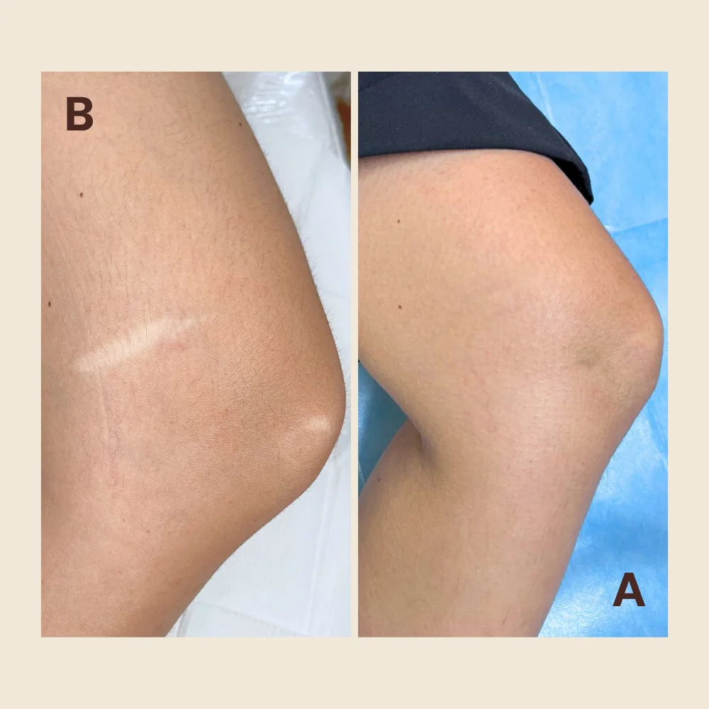 Before and after paramedical tattooing on a knee: a pale, raised scar above the kneecap before treatment, then blended to match the surrounding skin tone