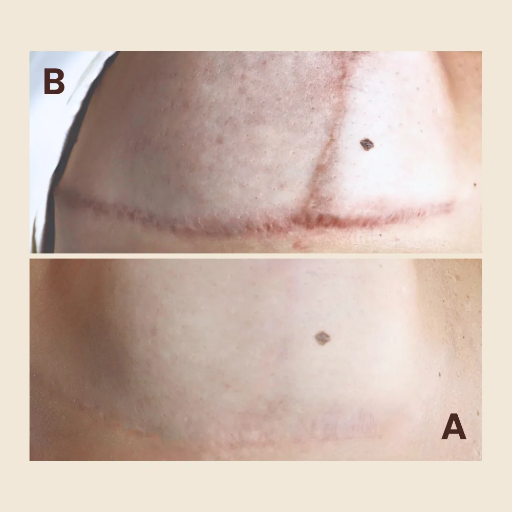 Before and after preparing a scar before camouflage tattoo: a raised, dark surgical scar in an inverted-T pattern on the torso, then flattened and faded to match the surrounding skin tone
