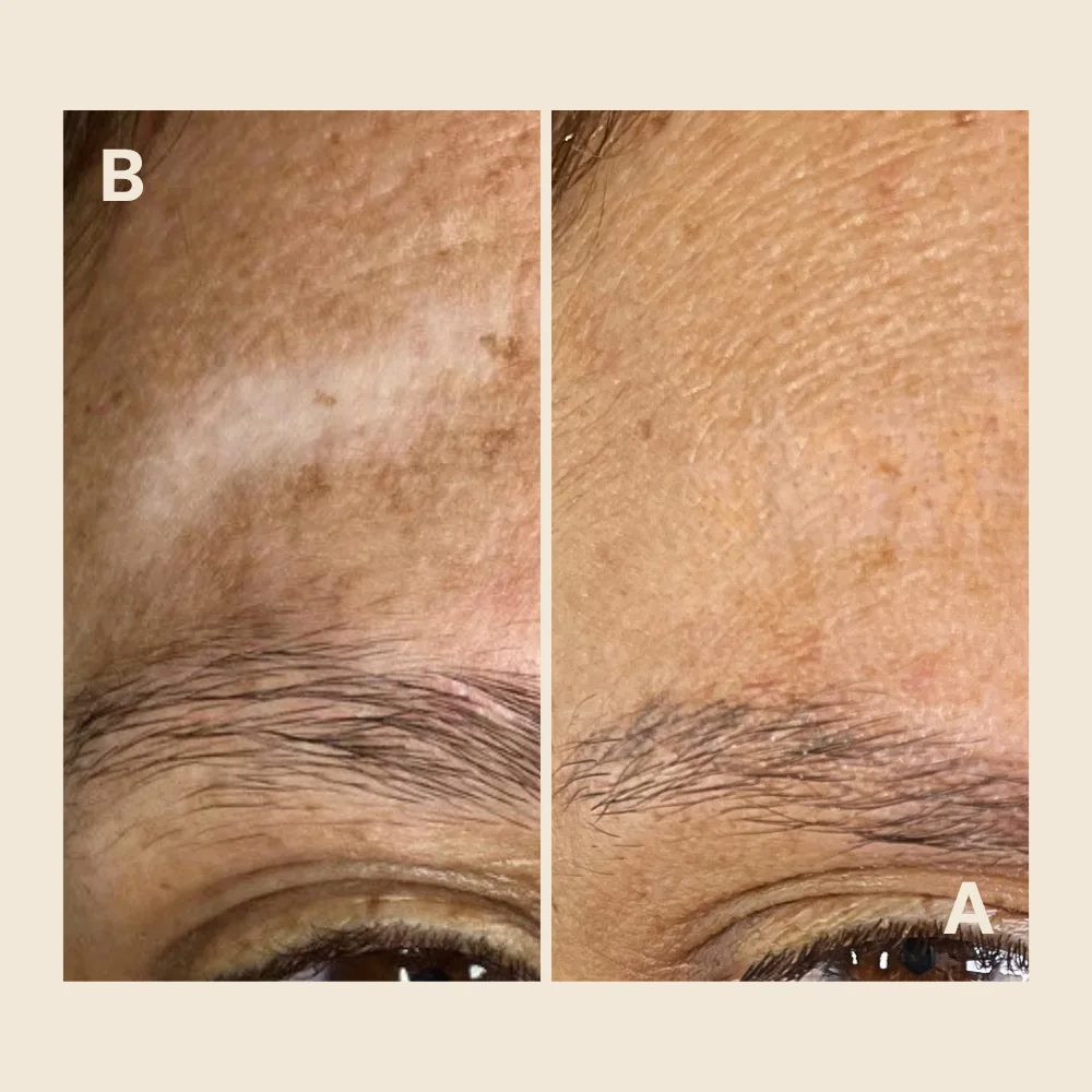 Before and after scar camouflage tattoo on the forehead above the eyebrow: a pale, hypopigmented scar before treatment, then blended to match the surrounding skin tone