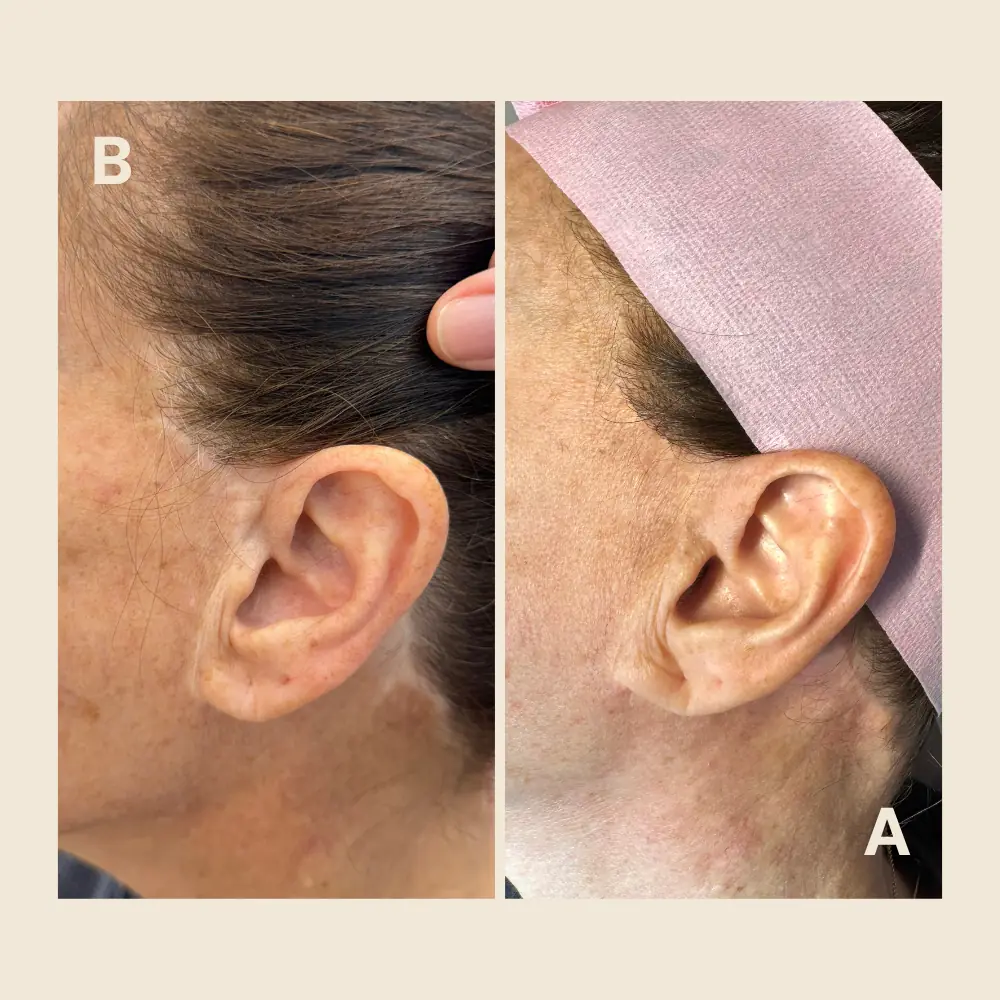 Before and after scar camouflage tattoo near the ear: the scar in front of the ear blends in with the surrounding skin tone