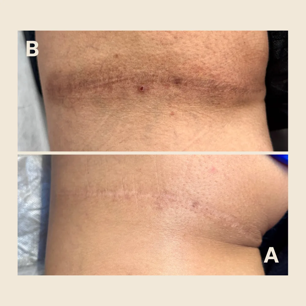 Starting Scar Treatment in Winter: Regeneration, Camouflage, and Results by Summer