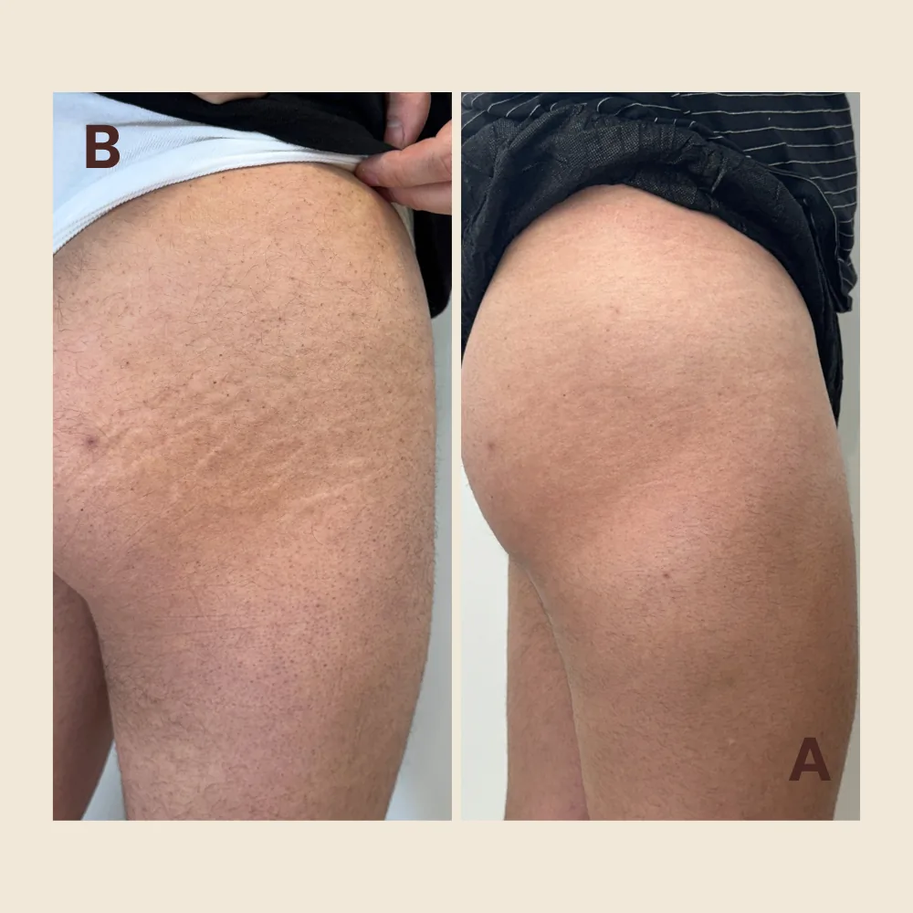 Before and after stretch mark camouflage on the hip: white stretch marks before treatment, then blended to match the surrounding skin tone.
