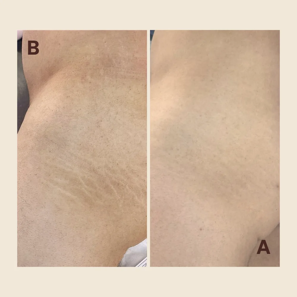 Stretch Mark Camouflage: How Tattooing Stretch Marks Works