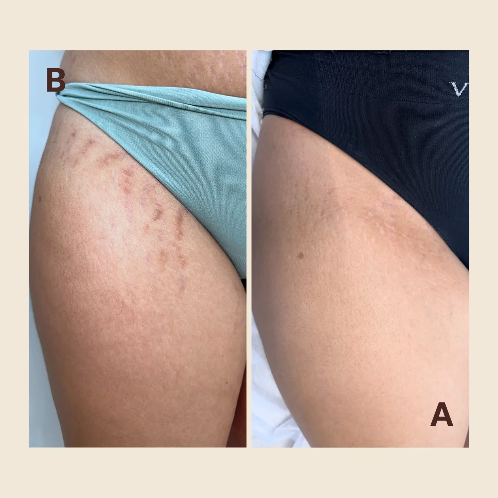 What Types of Stretch Marks Can Improve?
