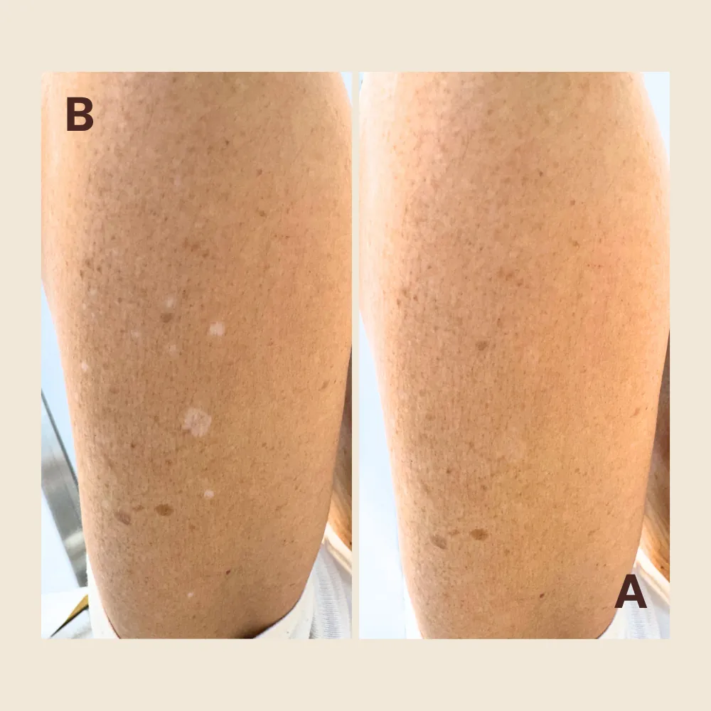 Before and after camouflage tattoo on a leg: small white sun-damage spots on tanned skin, then blended to match the surrounding skin tone